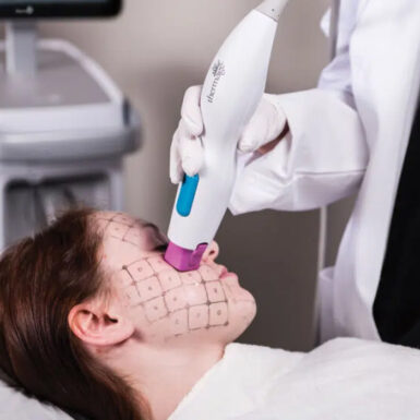 Thermage FLX – Image 2